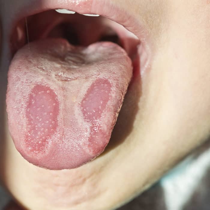 Cancer bucal y de garganta, Tratament complex al viermilor la copii