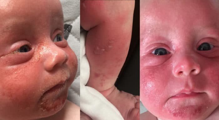 Ten Cuidado Con Quien Besa A Tu Bebe El Esta En Un Inmenso Dolor Luego De Que Alguien Con Herpes Lo Besara Familias Ten Cuidado Con Quien Besa A Tu Bebe El Esta En Un Inmenso Dolor Luego De Que Alguien Con Herpes Lo Besara Familias