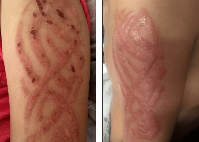Una persona con anemia se puede tatuar