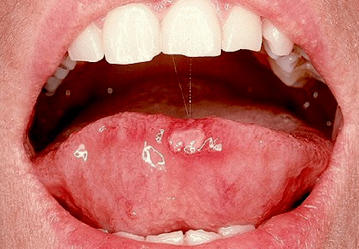 cancer bucal primeros sintomas