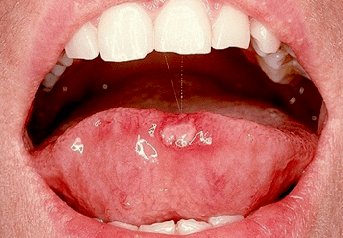 Sintomas cancer de lengua fotos