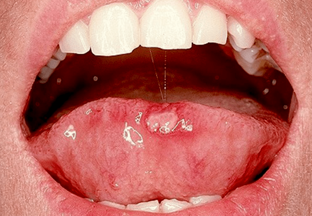 Cancer de lengua es curable