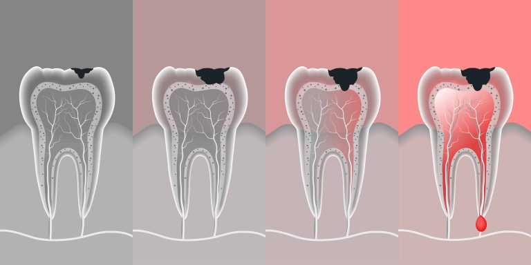 Remedios Naturales Para Curar La Caries Y Cuidar Tu Salud Bucal Familias