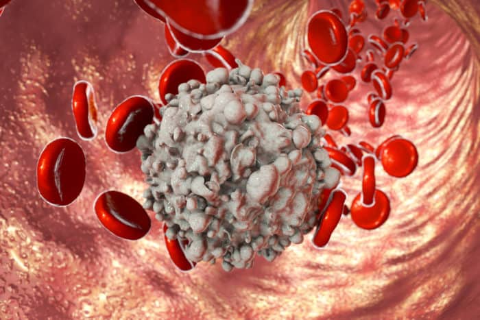 Encias leucemia